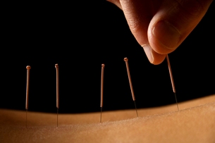 Akupunktur - Lolland Fysioterapi 
